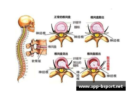 NBA球员腰椎间盘突出：症状、治疗及预防策略